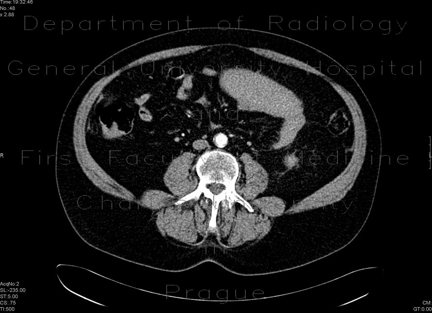 Venous infarzation of a jejunal loop