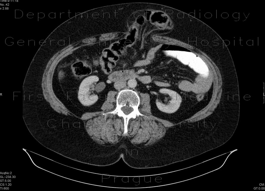 Ventral hernia, herniation of transverse colon