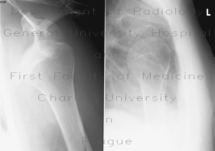 Ventrocaudal dislocation of shoulder