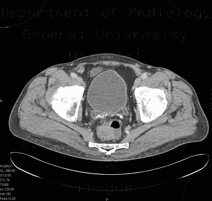 Radiology image - Vesicoureteral reflux: Abdomen, Urinary tract: CT - Computed tomography