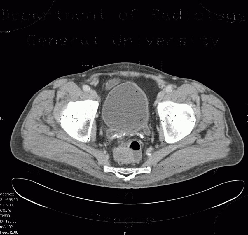Vesicoureteral reflux