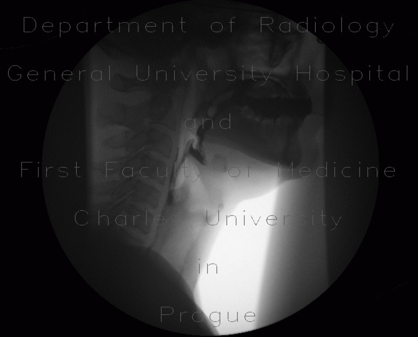 Radiology image - Videofluoroscopic swallow study: Head and Neck, Oesophagus, Oral cavity: RF - Fluoroscopy