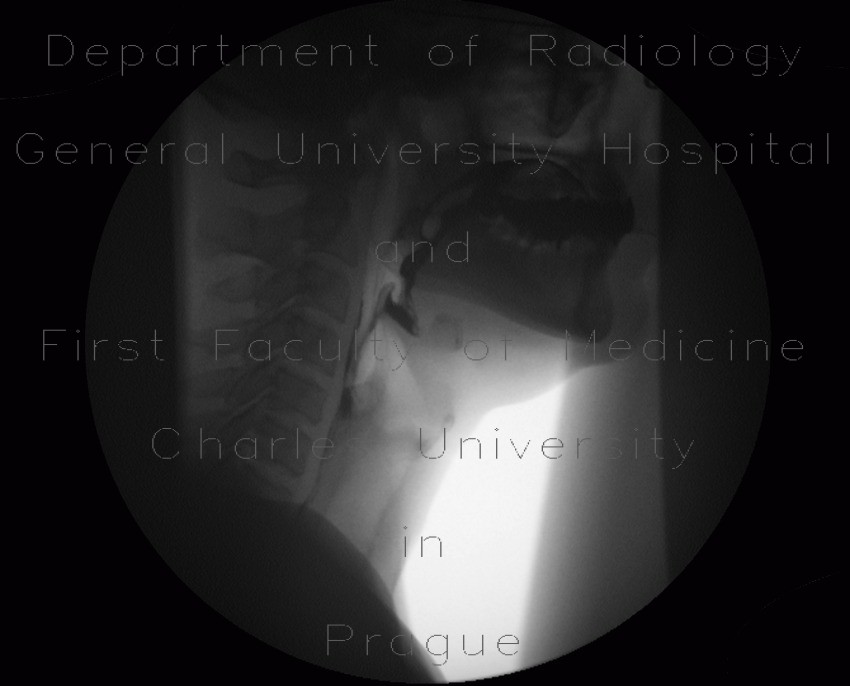 Videofluoroscopic swallow study