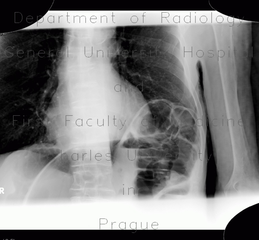 Volvulus of sigmoid colon