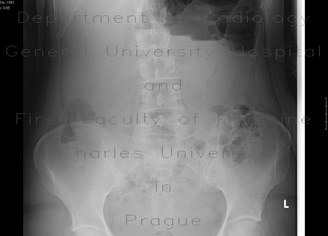 Radiology image - Volvulus, small bowel ileus: Abdomen, Peritoneal cavity, Small bowel: X-ray - Plain radiograph