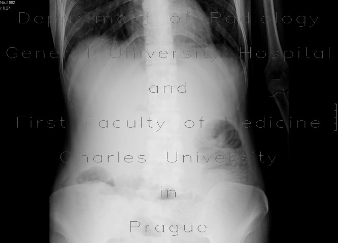 Radiology image - Volvulus, torsion of ileum, ileus: Abdomen, Peritoneal cavity, Small bowel: X-ray - Plain radiograph