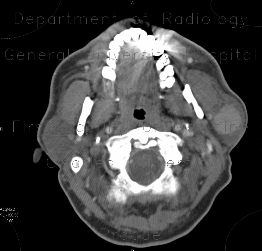 Radiology image - Warthin tumor, parotid gland: Head and Neck, Oral cavity, Soft tissue: CT - Computed tomography