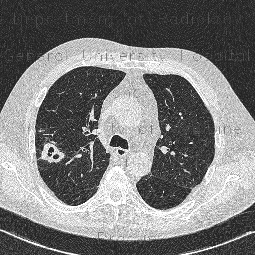 Wegener's granulomatosis