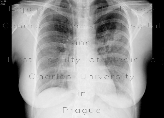 Wegener's granulomatosis