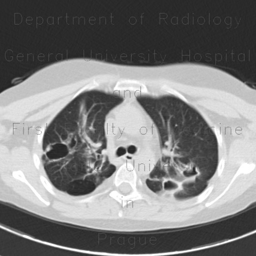 Wegener's granulomatosis, HRCT