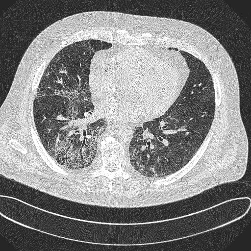 Radiology image - Wegener