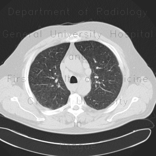 Radiology image - Welder