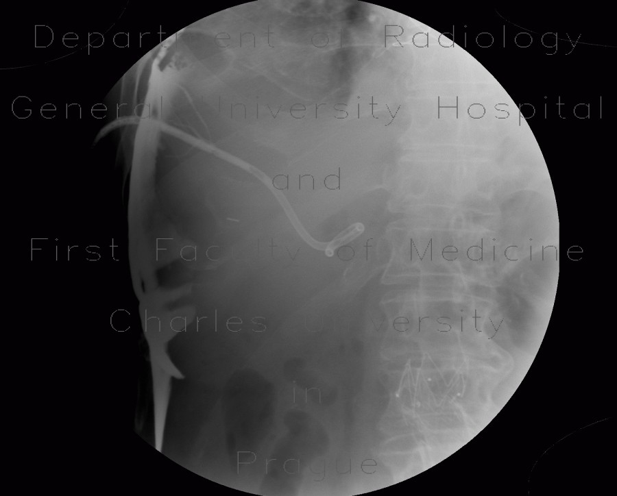 Radiology image - Whipple procedure, hepatico-jejuno anastomosis, biliary ascites, leak of anastomosis: Abdomen, Biliary tree, Peritoneal cavity: RF - Fluoroscopy