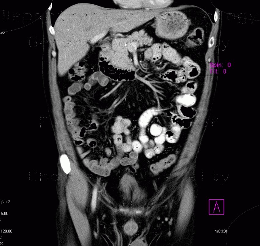 Radiology image - Wirsungolithiasis: Abdomen, Pancreas: CT - Computed tomography