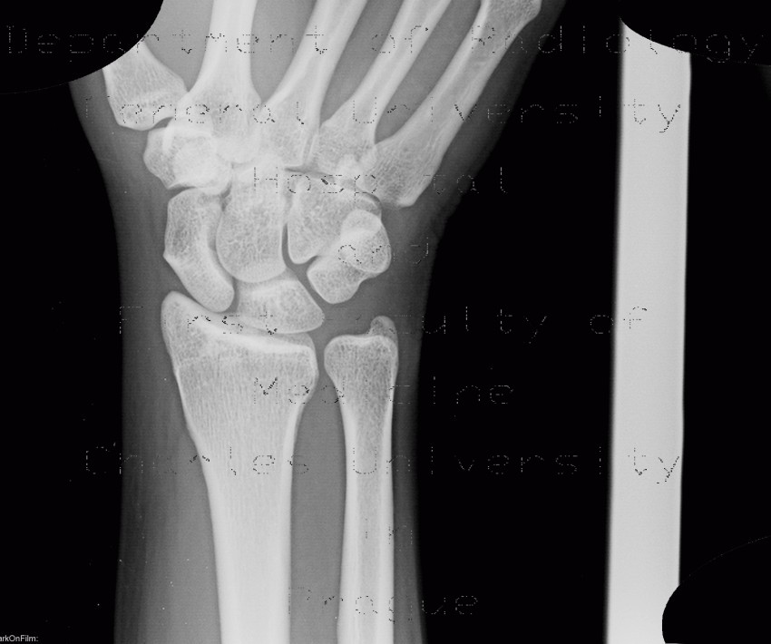 wrist bones xray