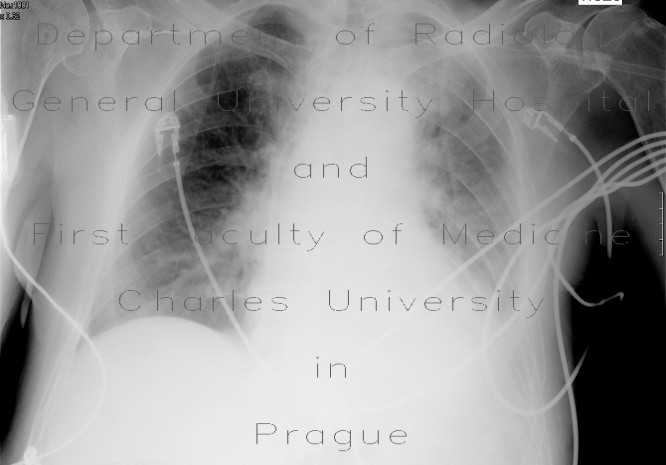 Radiology image - bronchial carcinoma, central, pneumonitis: Thorax, Lung: X-ray - Plain radiograph