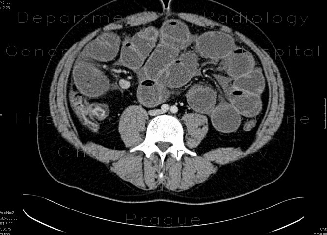 ileus, small bowel obstruction on terminal ileum