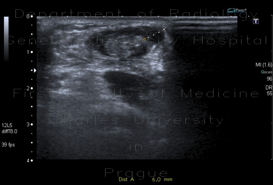 Radiology image - rupture of Achilles tendon: Extremity, Soft tissue: US - Ultrasound
