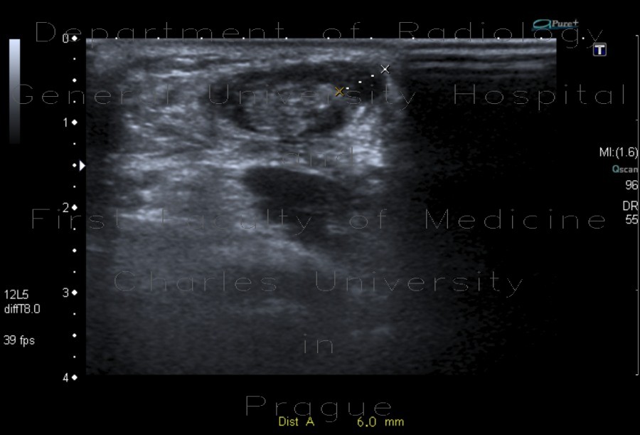 rupture of Achilles tendon