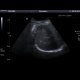 Liver hemangioma: US - Ultrasound