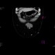 Scar hernia after laparoscopy: CT - Computed tomography