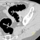 Polyp of sigmoid colon, dimitutive polyp, sessile polyp, CT colonography: CT - Computed tomography