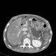 Venous congestion, thrombosis of superior mesenteric vein, ascites, steatosis of liver: CT - Computed tomography