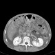 Venous congestion, thrombosis of superior mesenteric vein, ascites, steatosis of liver: CT - Computed tomography