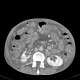 Venous congestion, thrombosis of superior mesenteric vein, ascites, steatosis of liver: CT - Computed tomography