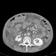 Venous congestion, thrombosis of superior mesenteric vein, ascites, steatosis of liver: CT - Computed tomography