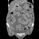 Venous congestion, thrombosis of superior mesenteric vein, ascites, steatosis of liver: CT - Computed tomography