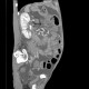 Venous congestion, thrombosis of superior mesenteric vein, ascites, steatosis of liver: CT - Computed tomography