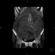 Venous congestion, thrombosis of superior mesenteric vein, ascites, steatosis of liver: CT - Computed tomography
