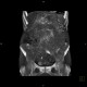 Venous congestion, thrombosis of superior mesenteric vein, ascites, steatosis of liver: CT - Computed tomography