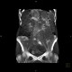 Venous congestion, thrombosis of superior mesenteric vein, ascites, steatosis of liver: CT - Computed tomography