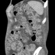 Venous congestion, thrombosis of superior mesenteric vein, ascites, steatosis of liver: CT - Computed tomography