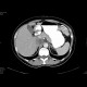 Tumorous mass in vena cava inferior: CT - Computed tomography