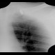 Gunshot wound, thorax, chest wall: X-ray - Plain radiograph