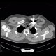 Gunshot wound, thorax, chest wall: CT - Computed tomography