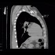 Gunshot wound, thorax, chest wall: CT - Computed tomography