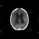 Meningencephalitis, abscessing: CT - Computed tomography