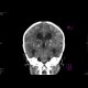 Meningencephalitis, abscessing: CT - Computed tomography