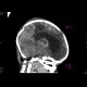 Meningencephalitis, abscessing: CT - Computed tomography