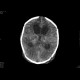 Meningencephalitis, abscessing: CT - Computed tomography