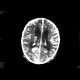 Meningencephalitis, abscessing: CT - Computed tomography