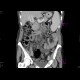 Portal cavernoma: CT - Computed tomography