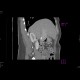 Portal cavernoma: CT - Computed tomography