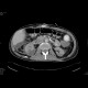 Kidney laceration: CT - Computed tomography