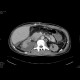 Kidney laceration: CT - Computed tomography