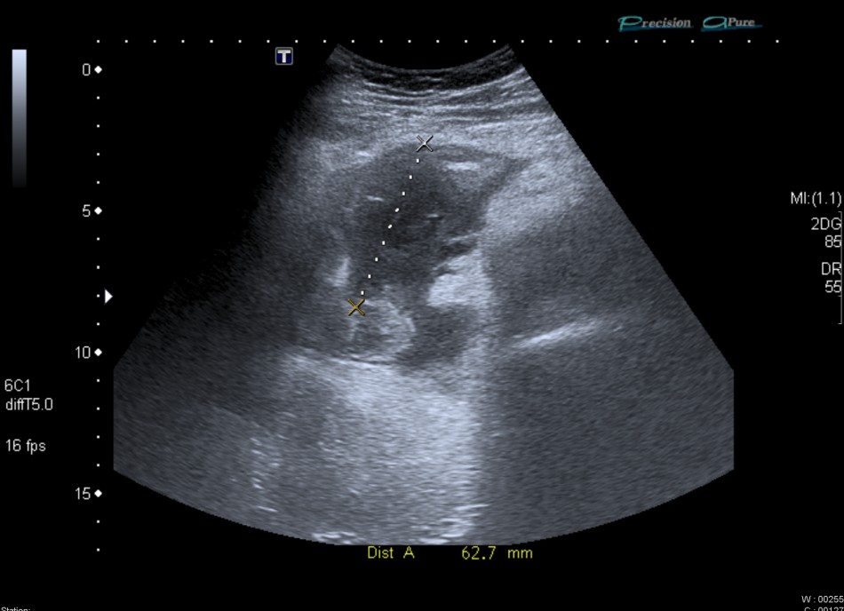 Radiology case: Abscess, Crohn's disease, intra-abdominal abscess
